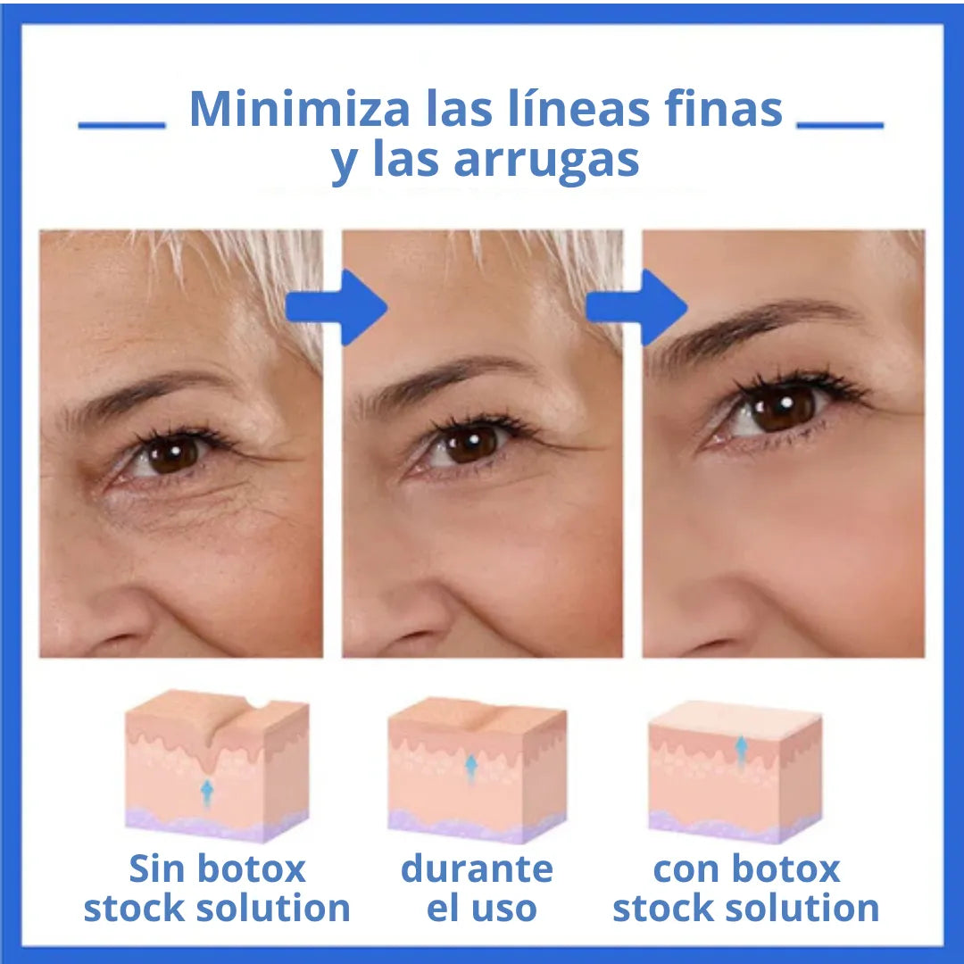 Botox Stock Solution - Rejuvenece tu Belleza Natural