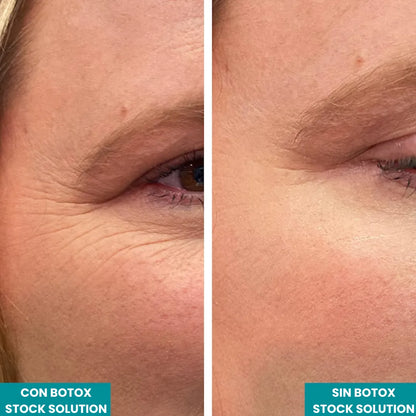 Botox Stock Solution - Rejuvenece tu Belleza Natural